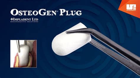 Osteogen® Plug One Step Bone Grafting Solution Youtube