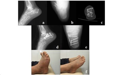 A 36-year-old male patient had a right calcaneal fracture as a result ...