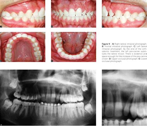 Figure From Reconstruction Of Alveolar Cleft With Allogenous Bone