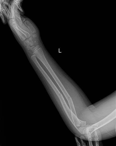 Greenstick Fractures Radius And Ulna Image