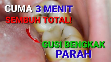 3 Menit Cara Mengobati Gusi Bengkak Karena Gigi Berlubang Dan Di Dalam