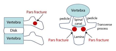 What is Pars Interarticularis Defect? Symptoms, Treatment, & Causes