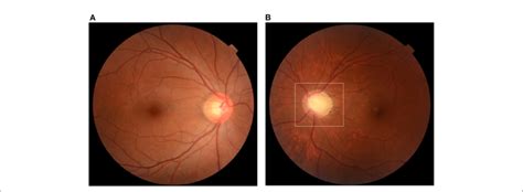 FIGURE E Optic disc cupping. Fundus photograph captured from a ...