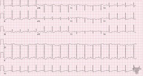 Global Subendocardial Ischemia Ecg Stampede