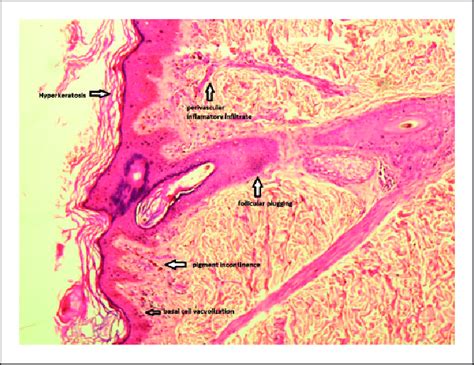 Skin Biopsy Specimen On Histopathology Showing Hyperkeratosis And