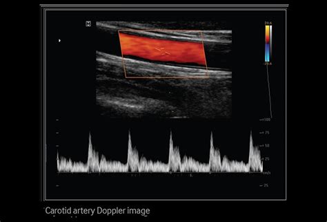 carotid-artery-doppler-image-min - Bio Imaging