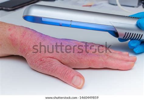 Phototherapy Dermatosis Treatment Skin Diseases Psoriasis Stock Photo ...