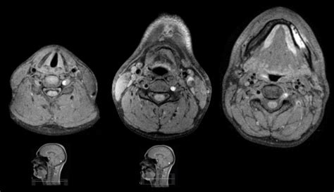 Vertebral Artery Dissection Mri