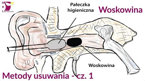 Woskowina Metody Usuwania Cz 1 Jak Skutecznie I Bezpiecznie