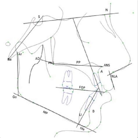 Lateral Cephalometric Reference Landmarks Planes And Angles Analysed Download Scientific