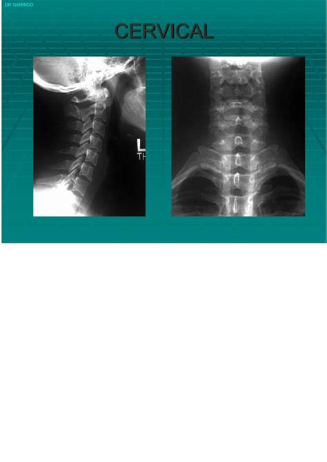 Pdf Lesiones De Columna Cervical Dokumen Tips