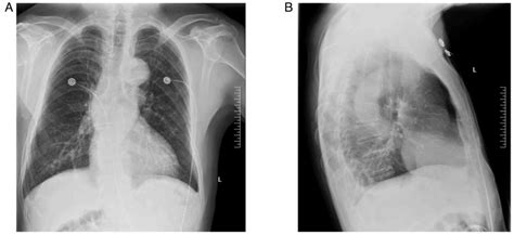 Type B Thymoma Complicated With Chlamydia Psittaci Pneumonia With Rare