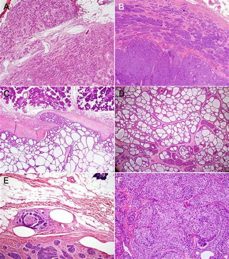 Basal Cell Adenocarcinoma Of The Salivary Gland A Morphological And