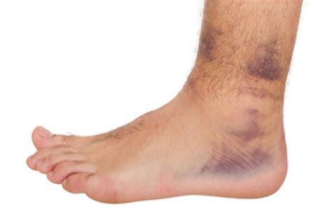 Grading Of Ankle Sprains Blog