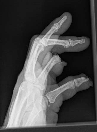 Traumatic Finger Amputation Image Radiopaedia Org