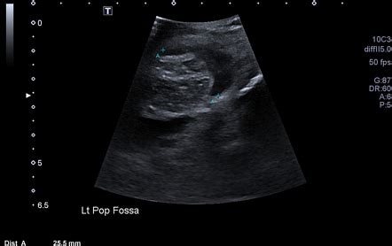 Baker cyst rupture | Radiology Case | Radiopaedia.org