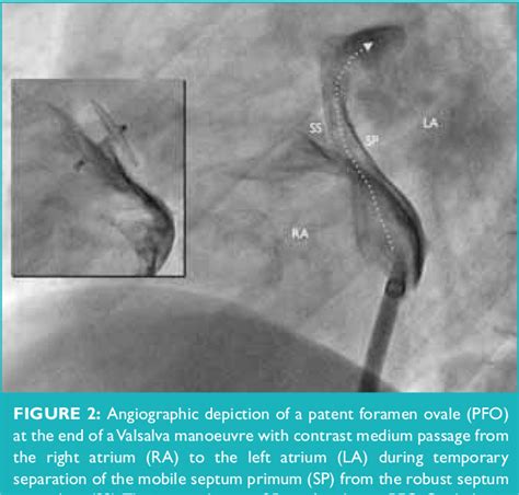 Figure 1 From Closure Of Patent Foramen Ovale For Secondary Prevention