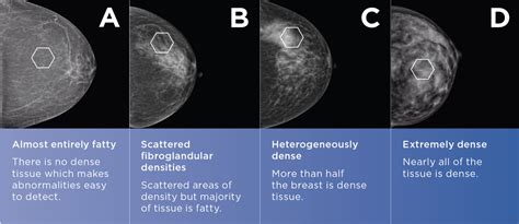 Breast Cancer Risk And Breast Density Is Age A Factor Mayfair