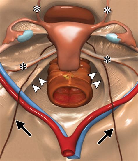 Surgical Anatomy Of The Uterosacral Ligament Colpopexy Female Pelvic