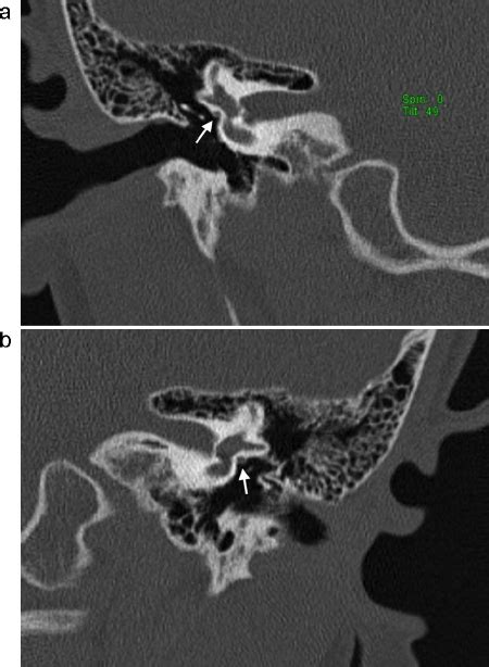 Axial Ct Section Showing The Facial Nerve Running Over The Oval Window Download Scientific