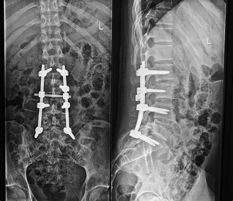 Laminectomy X Ray