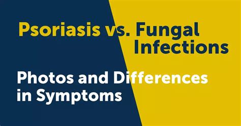 Psoriasis Vs Fungal Infections Photos And Differences In Symptoms