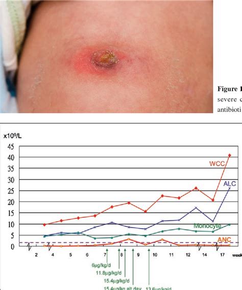 Omphalitis