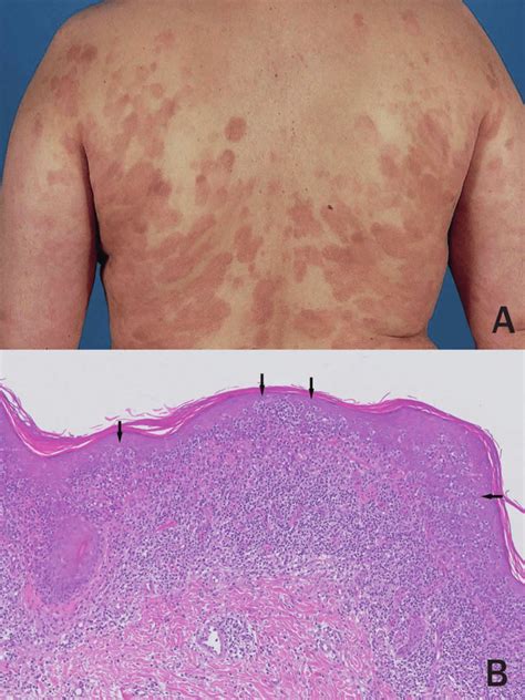 Mycosis Fungoides Symptoms