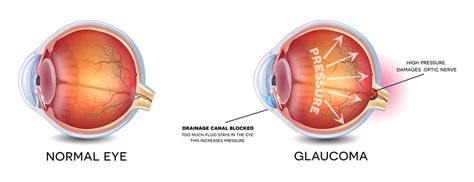 glaucoma    treatable