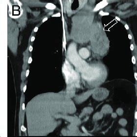 Chest CT With IV Contrast Axial A Coronal B And Sagittal C