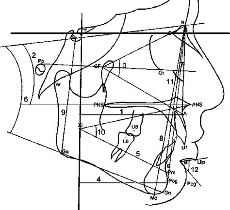 Skeletal And Soft Tissue Measurements On Lateral Cephalograms 1 A CTV