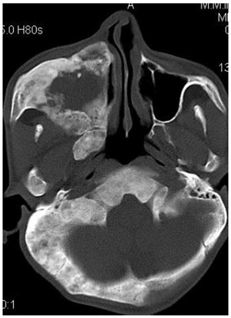 Fibrous Dysplasia Of Maxilla