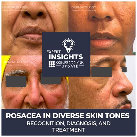 What Are Treatments For Rosacea