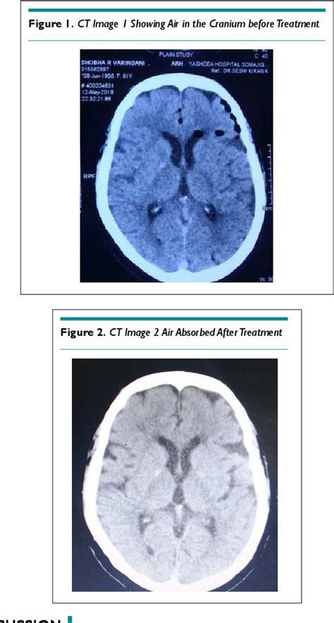 Figure From Pneumocephalus Caused By An Epidural Ozone Injection For