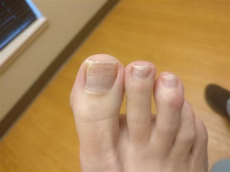 White Patches On Toenails [causes Signs And Best Treatment]