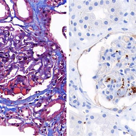 Glomerulus With Capillary Thrombi A Capillary Thrombi Arrow