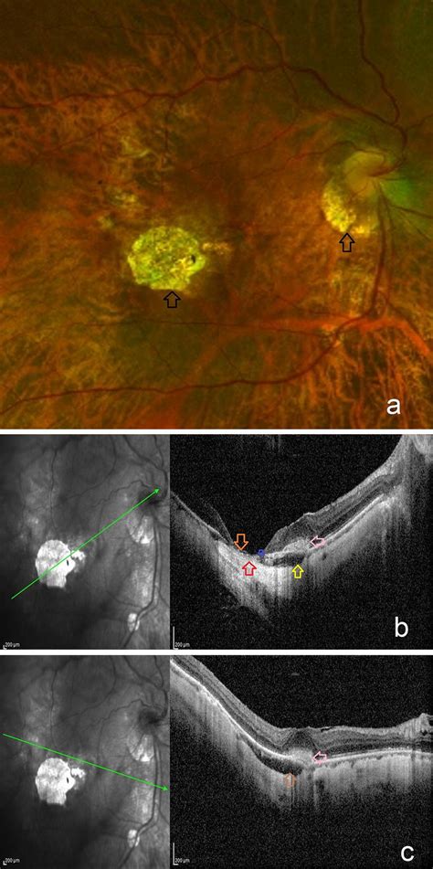 Posterior Scleral Displacement With The Presence Of Focal Chorioretinal Download Scientific