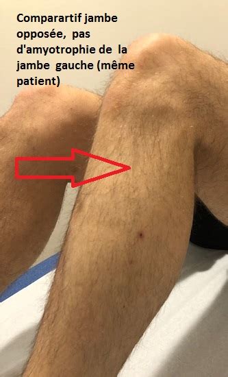 Compression Of The External Popliteal Sciatic Nerve Spe Restless Leg