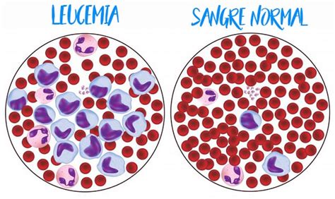 Leucemia Mieloide Qué es Síntomas tratamiento diagnóstico y mucho más