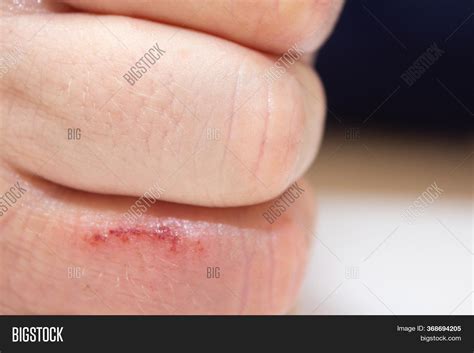 Hand Dermatitis. Hand Image & Photo (Free Trial) | Bigstock