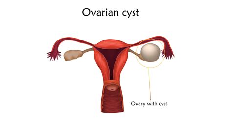 Ovarian Cysts The Pelvic Clinic Atelier Yuwa Ciao Jp