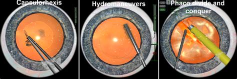 Figure 1 From Clinical Ophthalmology Dovepress Dovepress Ready For Or