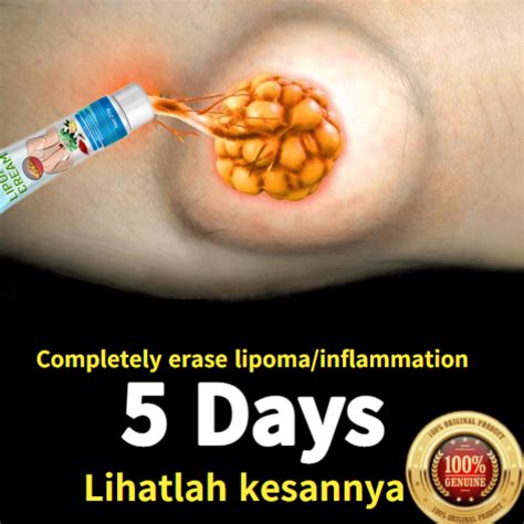 Lipoma Cream Benjolan Ubat Benjolan Lipoma Removal Cream Removal