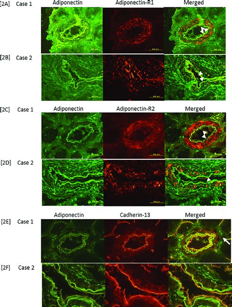 ADPN AdipoR1 R2 And Cadherin 13 T Cadherin Expression In Renal