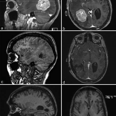 Pre Operative MRI Of Brain Showing A Solitary Heterogeneously Enhancing