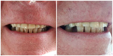 Complete Upper Denture | Kelowna Denture Clinic