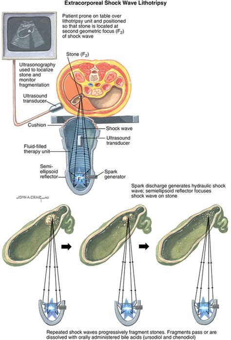 The Mysterious Sound Of Crushing Stones: A Guide To Pronouncing Extracorporeal Shock Wave Lithotripsy