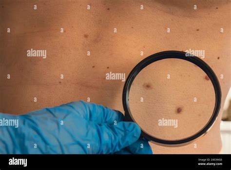 Unrecognizable Dermatologist Examining Patient S Birthmark With