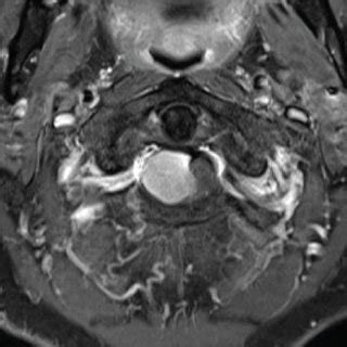 (a) T2-weighted sagittal MRI of the cervical spine showed a tumor in ...