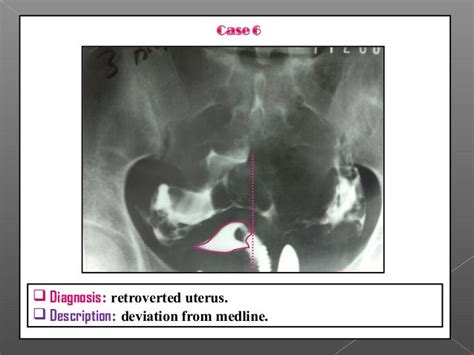 Hysterosalpingography